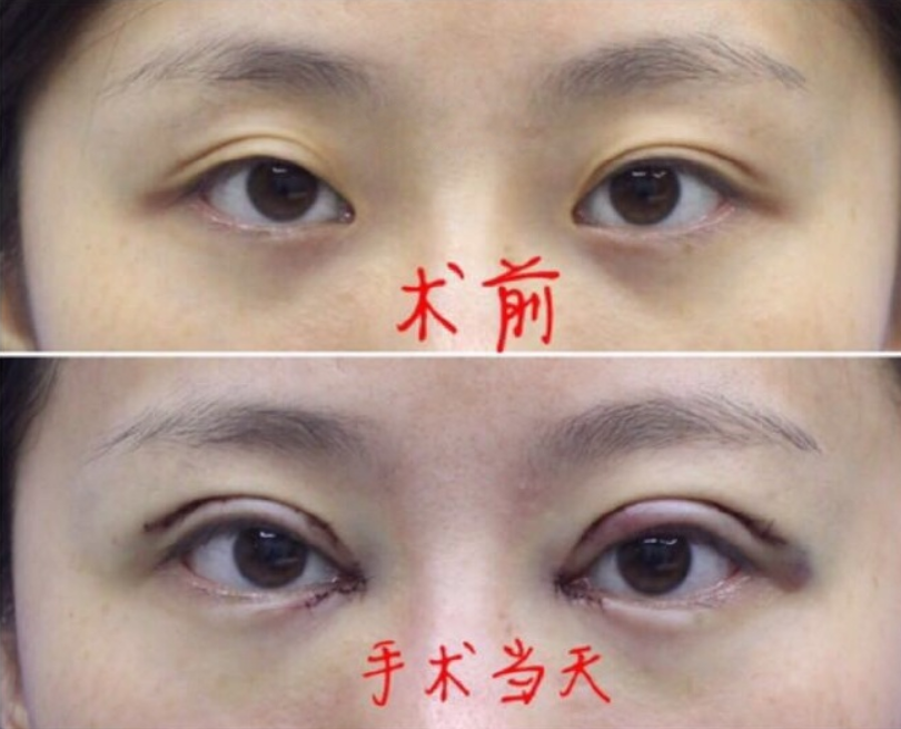 杭州高寿松医生做的全切双眼皮、内眼角