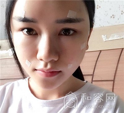 上海仁爱,杨苓山,面部填充,案例,价格,