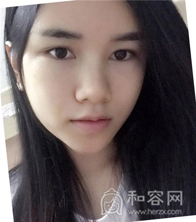 上海仁爱,杨苓山,面部填充,案例,价格,