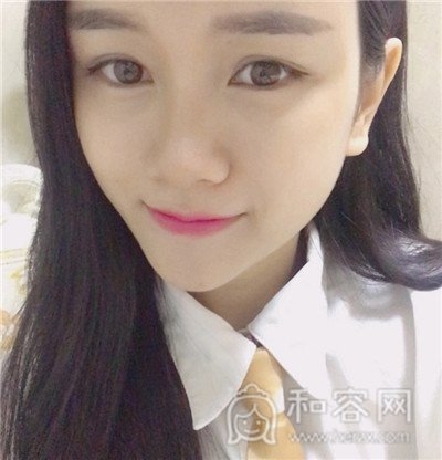 上海仁爱,杨苓山,面部填充,案例,价格,
